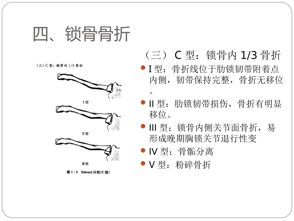 骨与关节骨折分型_第9页