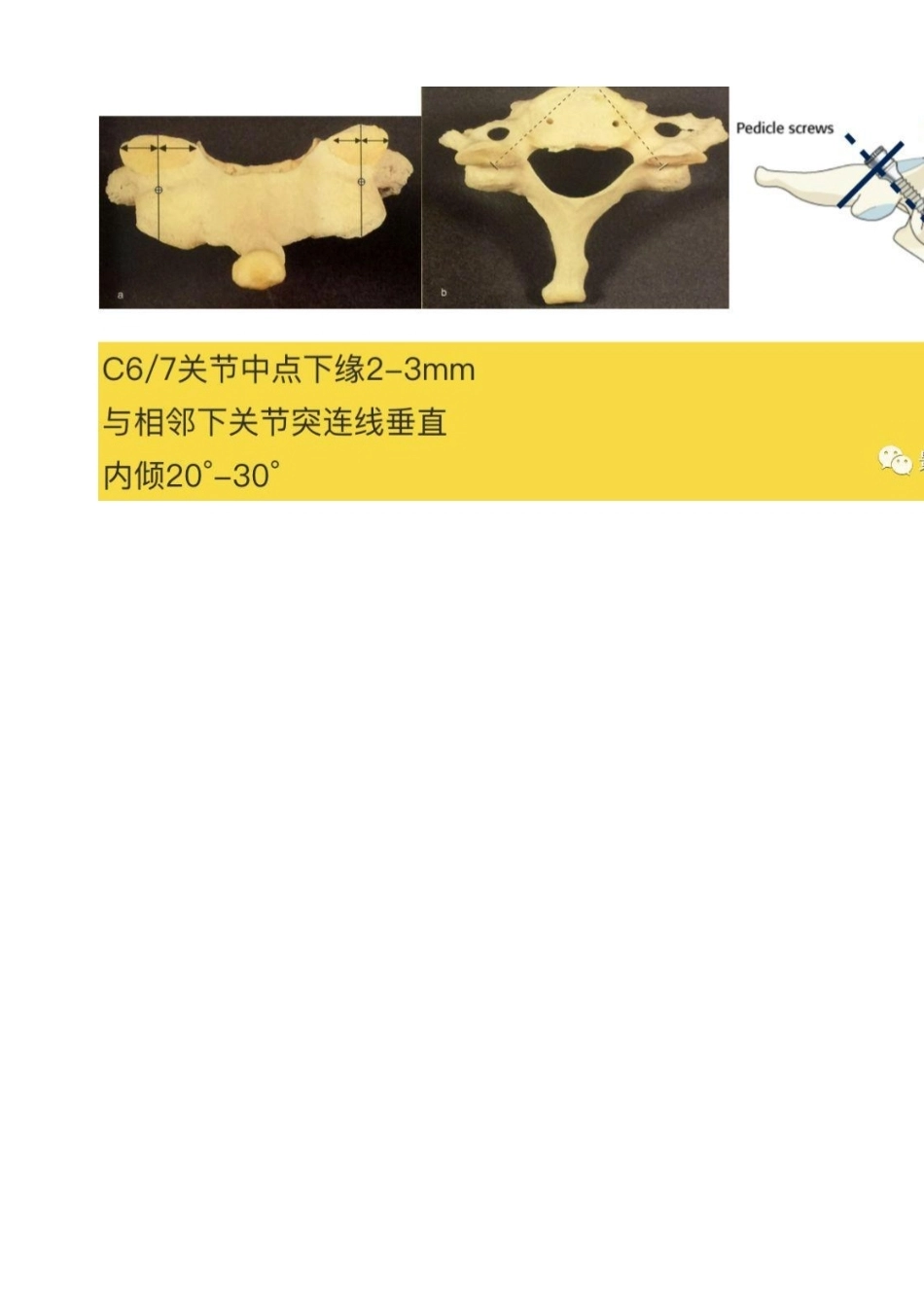 胸椎颈椎腰椎椎弓根置钉技术_第10页