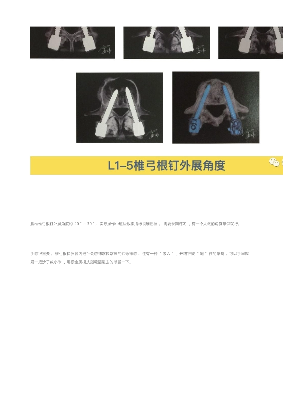 胸椎颈椎腰椎椎弓根置钉技术_第14页