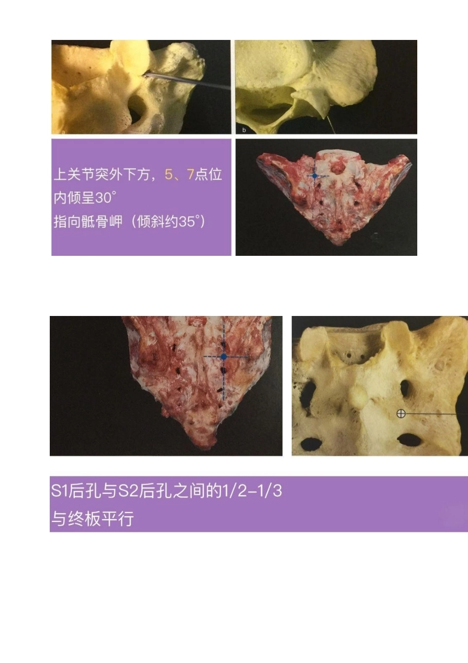 胸椎颈椎腰椎椎弓根置钉技术_第15页