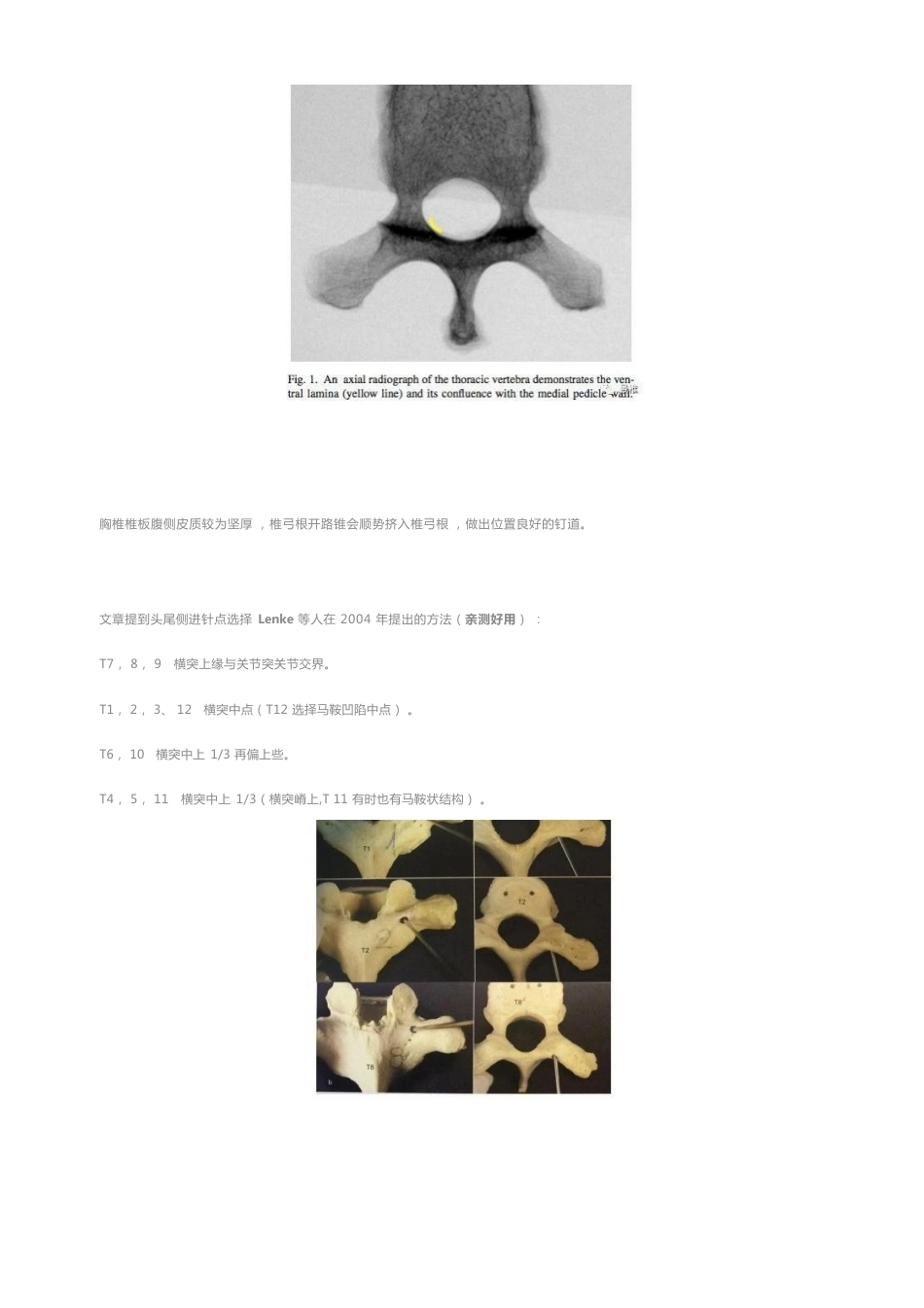 胸椎颈椎腰椎椎弓根置钉技术_第2页
