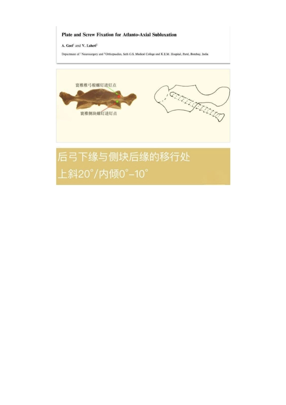 胸椎颈椎腰椎椎弓根置钉技术_第4页