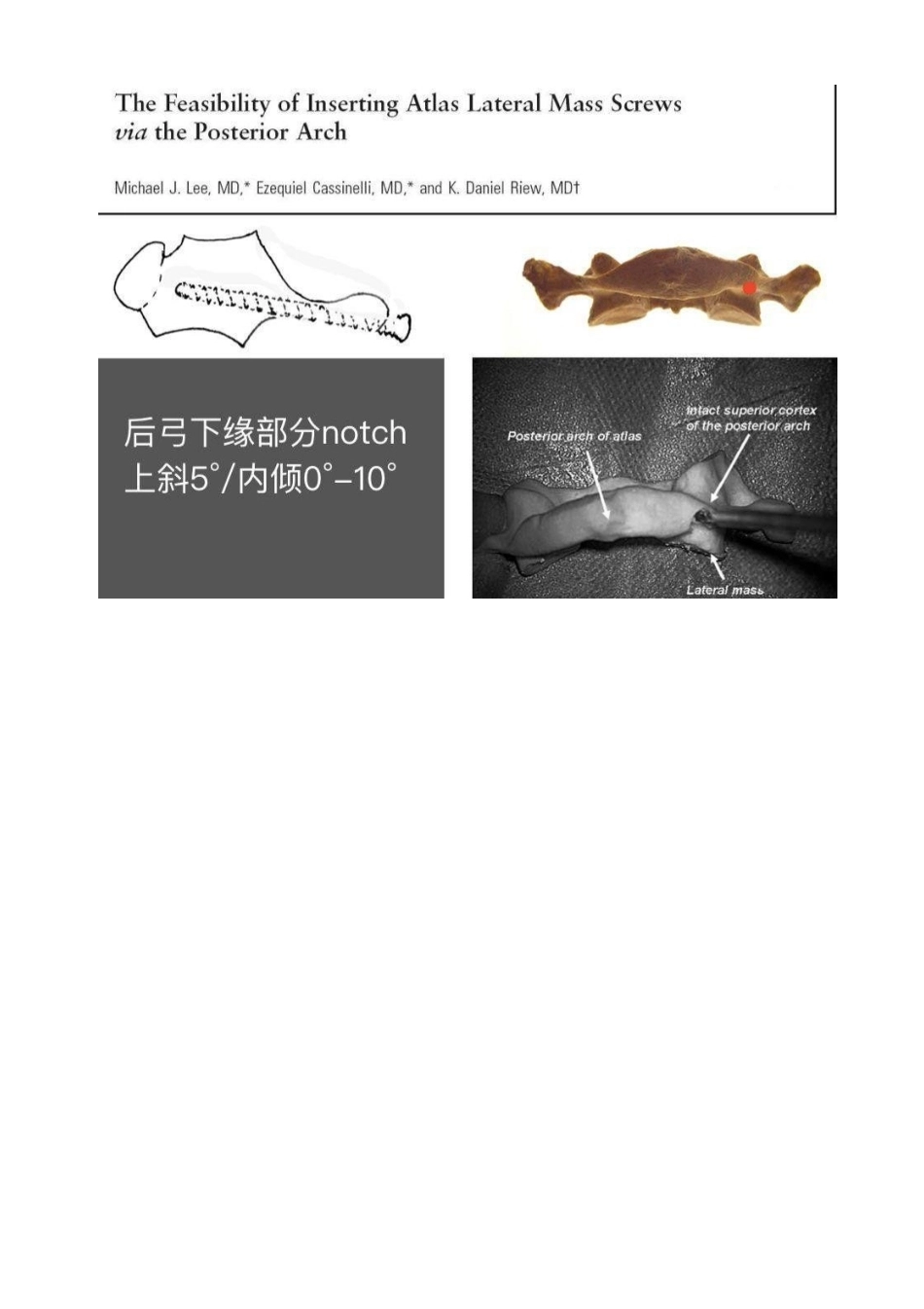 胸椎颈椎腰椎椎弓根置钉技术_第5页