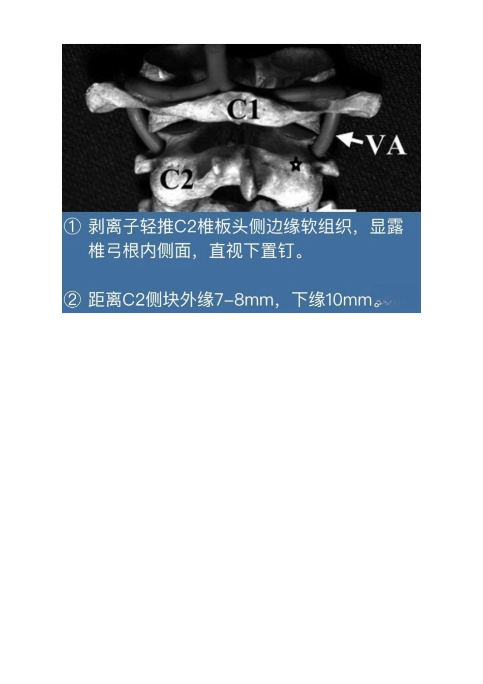 胸椎颈椎腰椎椎弓根置钉技术_第7页