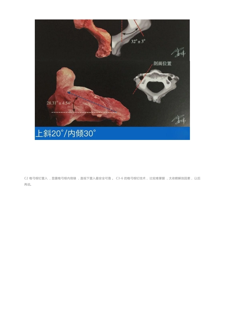 胸椎颈椎腰椎椎弓根置钉技术_第8页