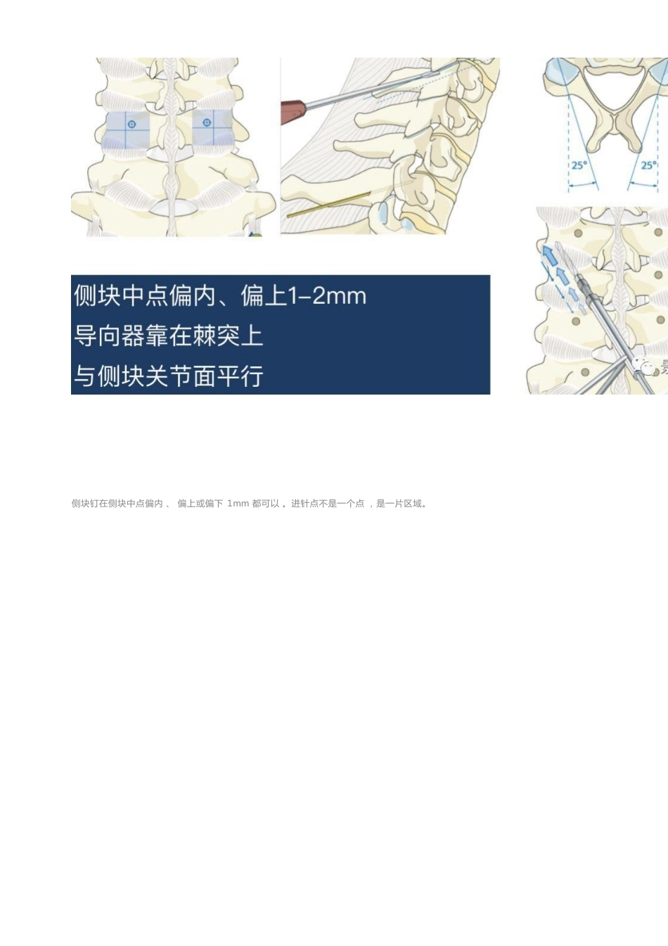 胸椎颈椎腰椎椎弓根置钉技术_第9页