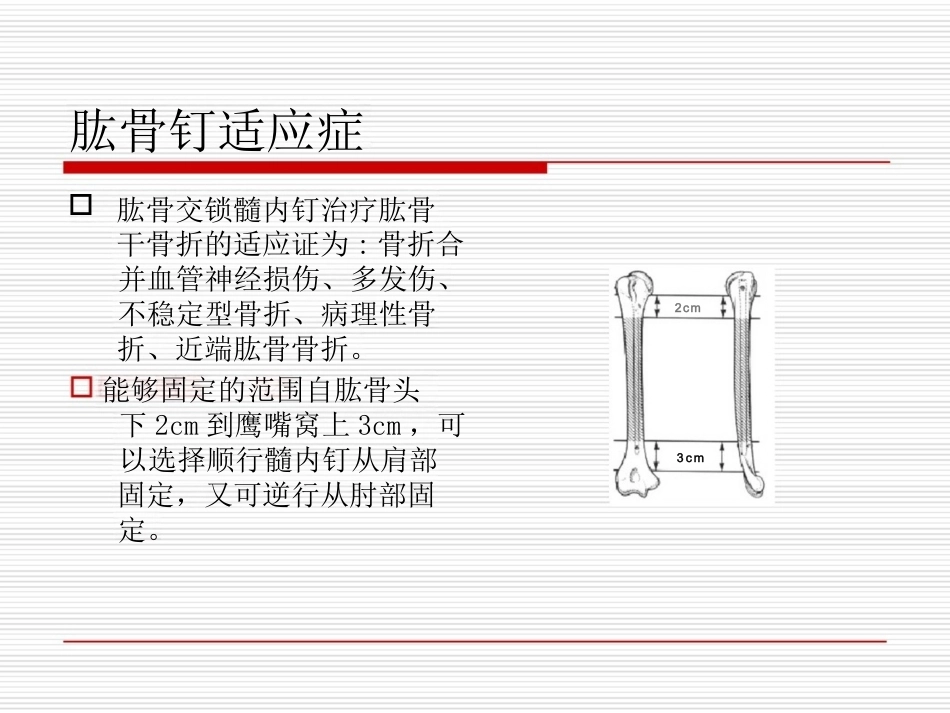 髓内钉应用的基本原则_第11页