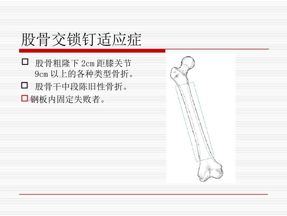 髓内钉应用的基本原则_第14页