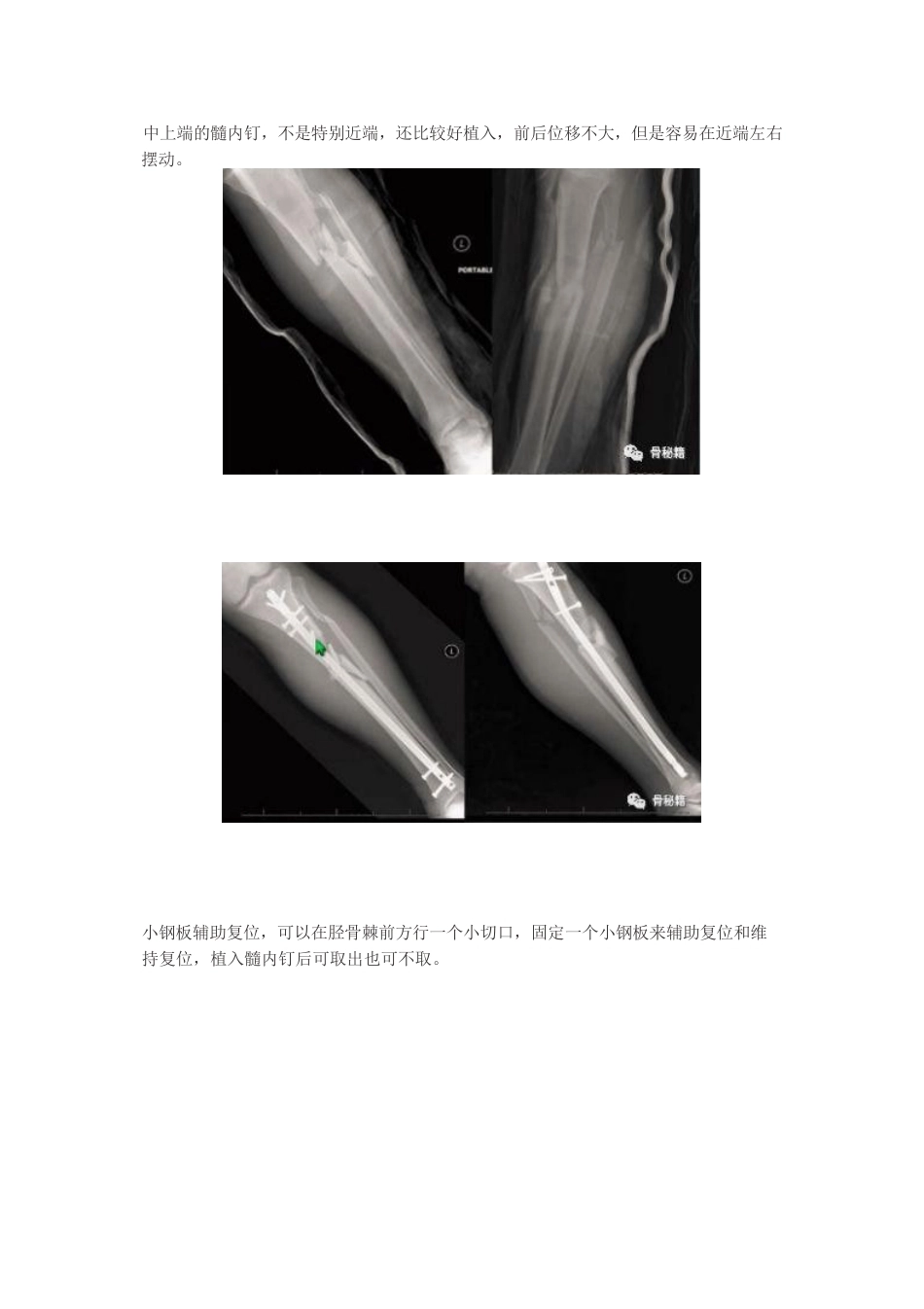 胫骨近端髓内钉植 入技巧_第10页