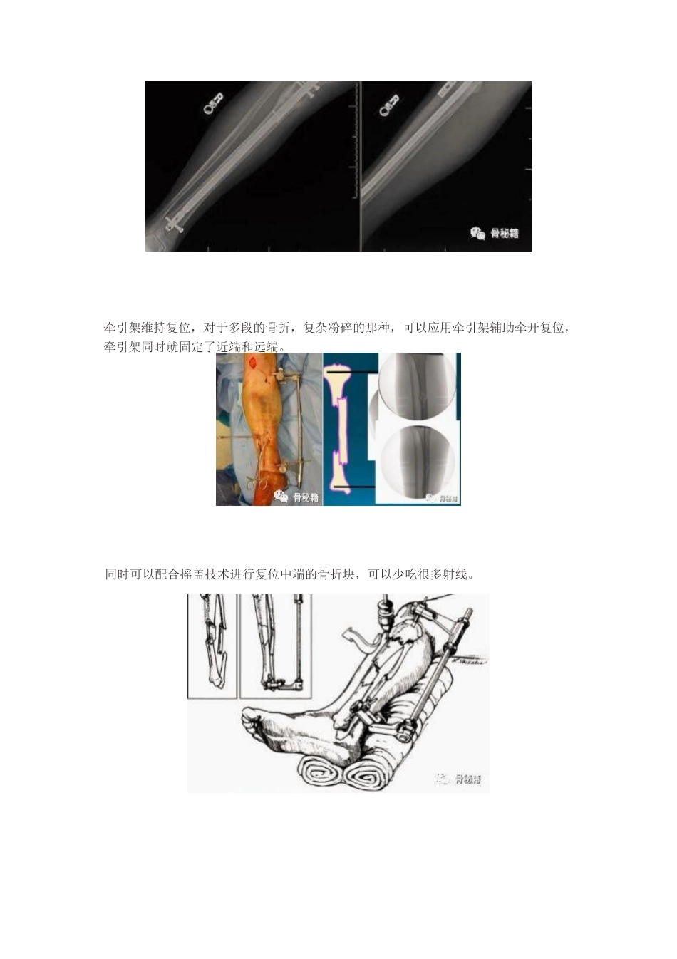 胫骨近端髓内钉植 入技巧_第12页