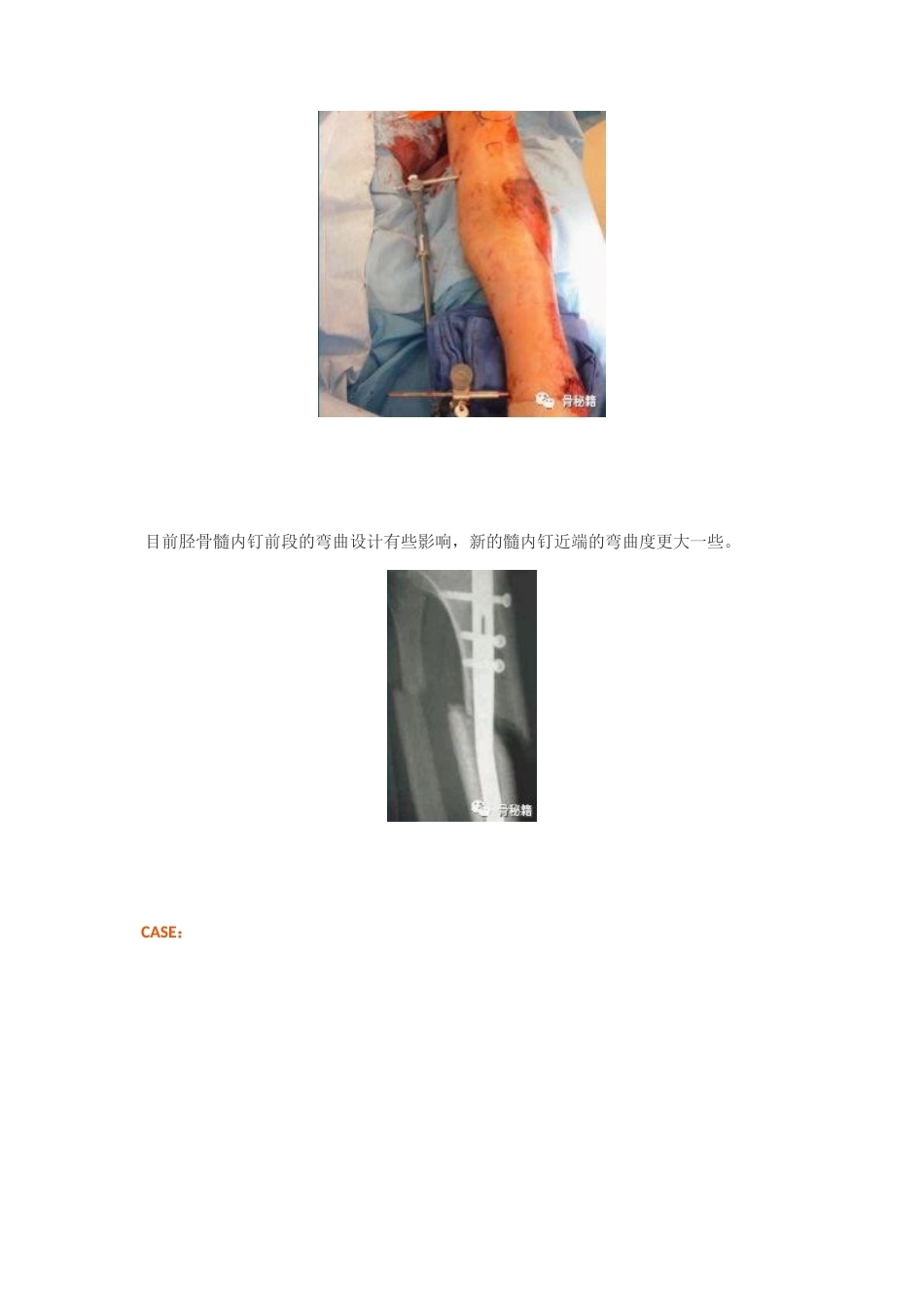 胫骨近端髓内钉植 入技巧_第13页
