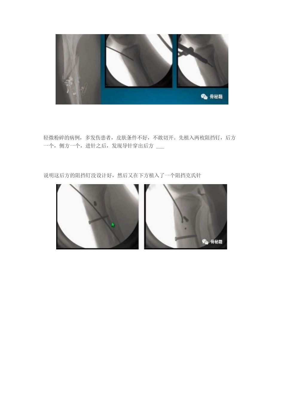 胫骨近端髓内钉植 入技巧_第14页
