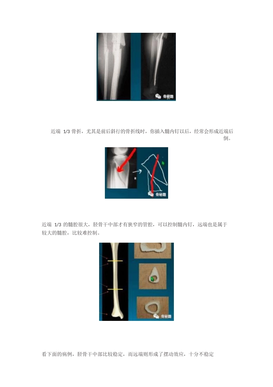 胫骨近端髓内钉植 入技巧_第3页