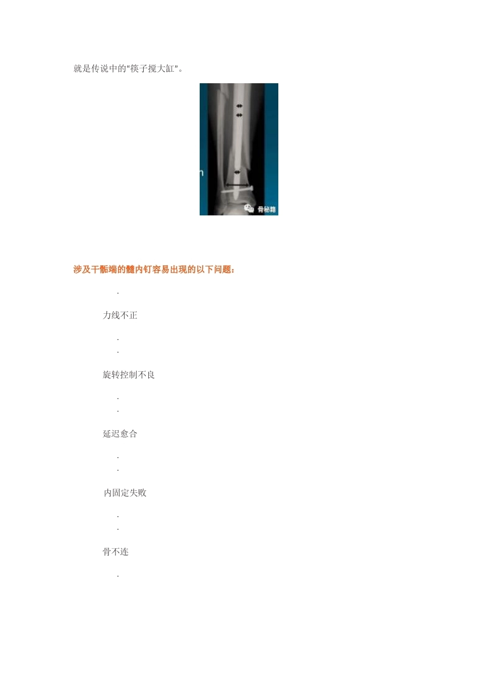 胫骨近端髓内钉植 入技巧_第4页