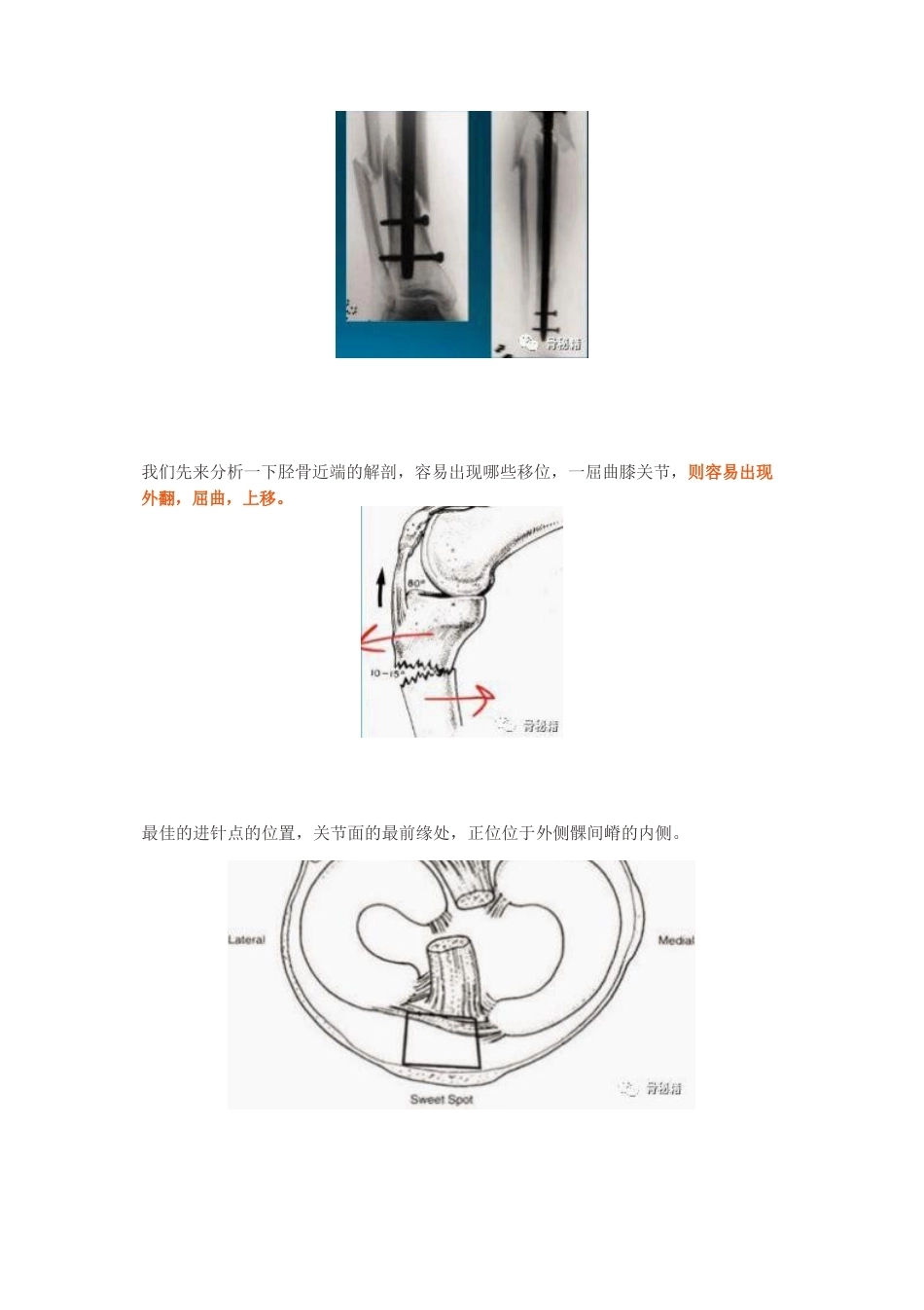 胫骨近端髓内钉植 入技巧_第5页