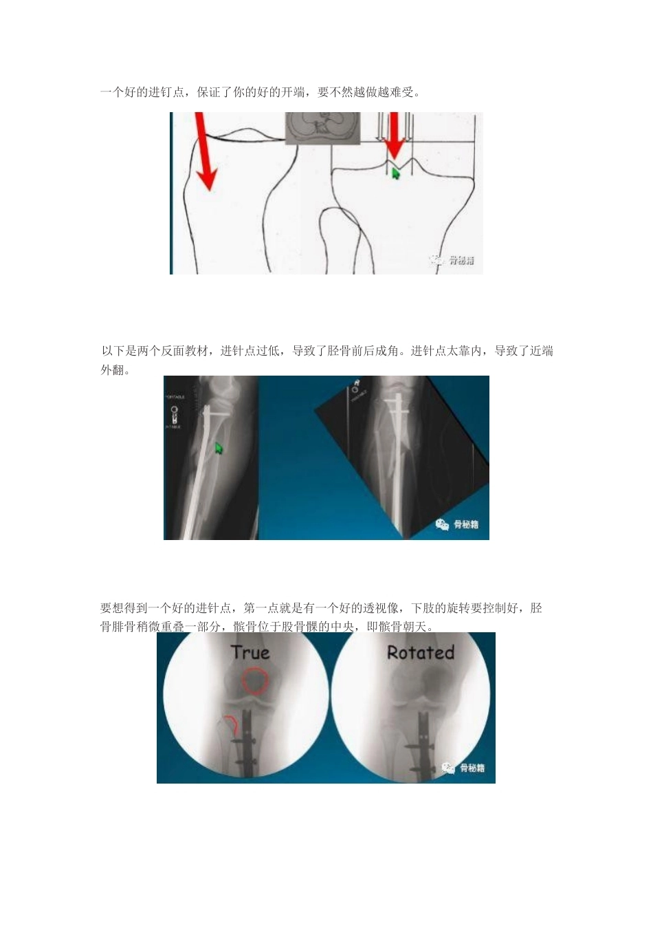 胫骨近端髓内钉植 入技巧_第6页