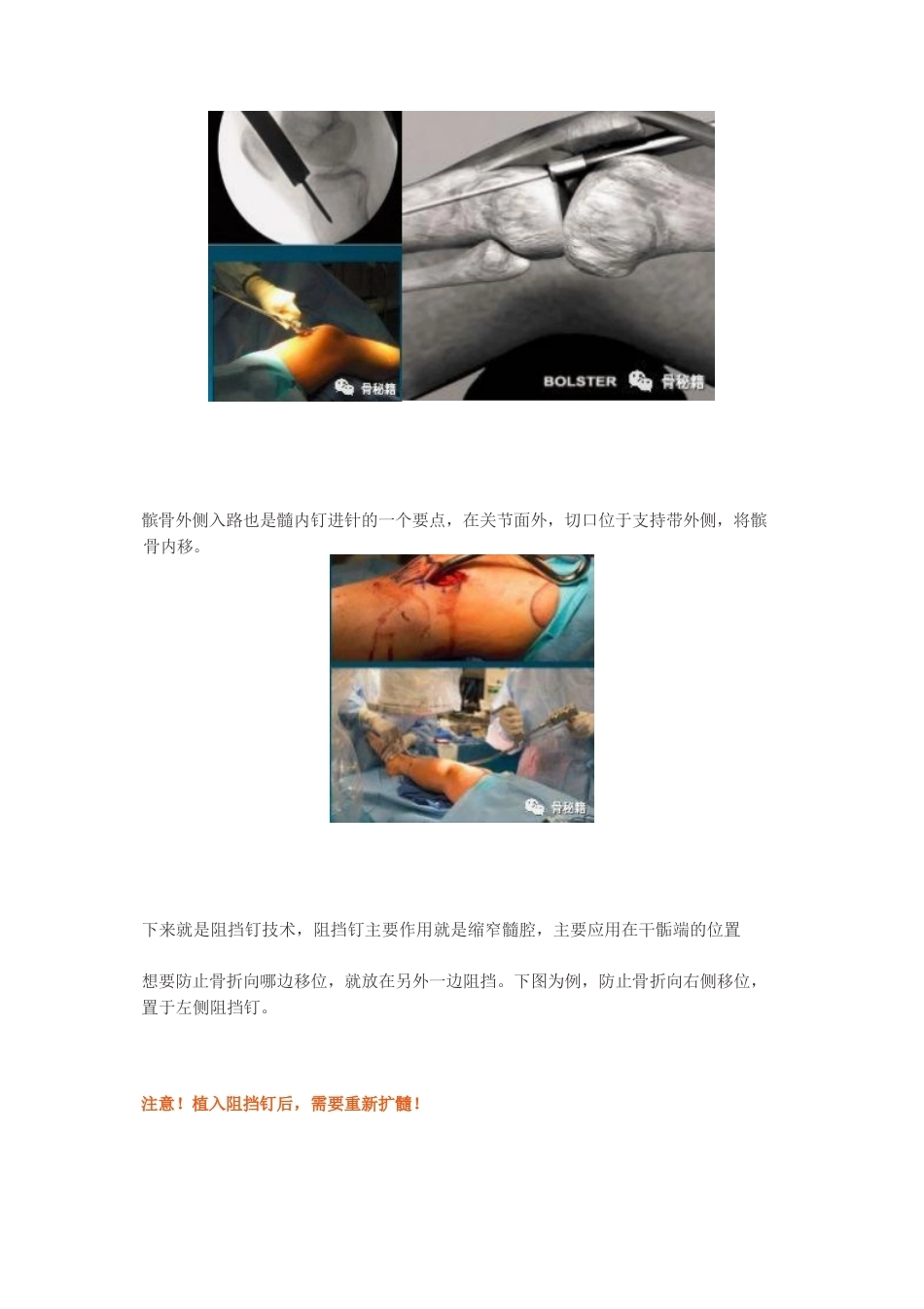 胫骨近端髓内钉植 入技巧_第8页