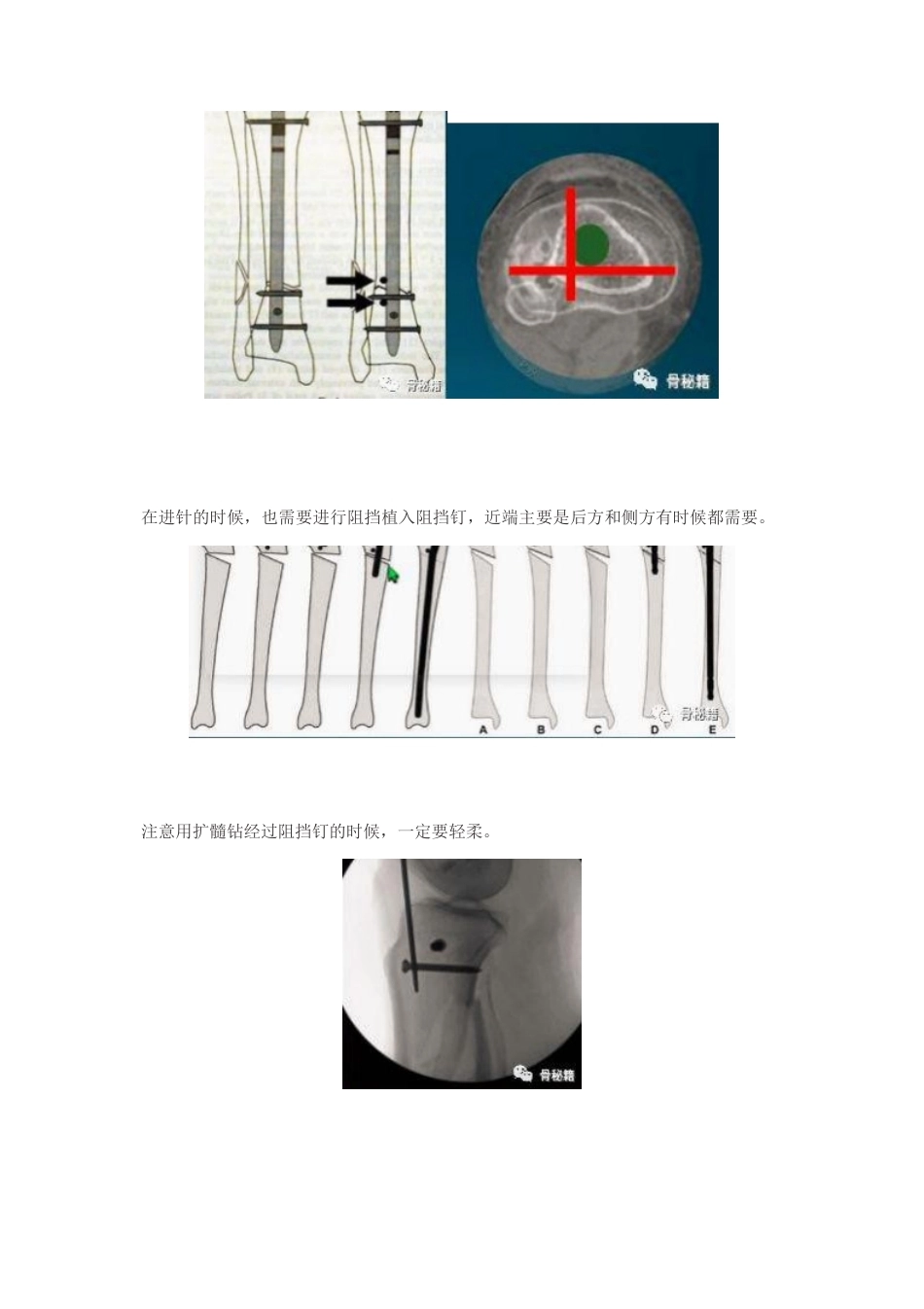 胫骨近端髓内钉植 入技巧_第9页