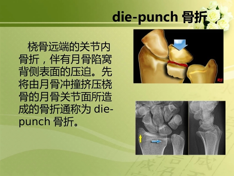 特殊类型骨折_第11页