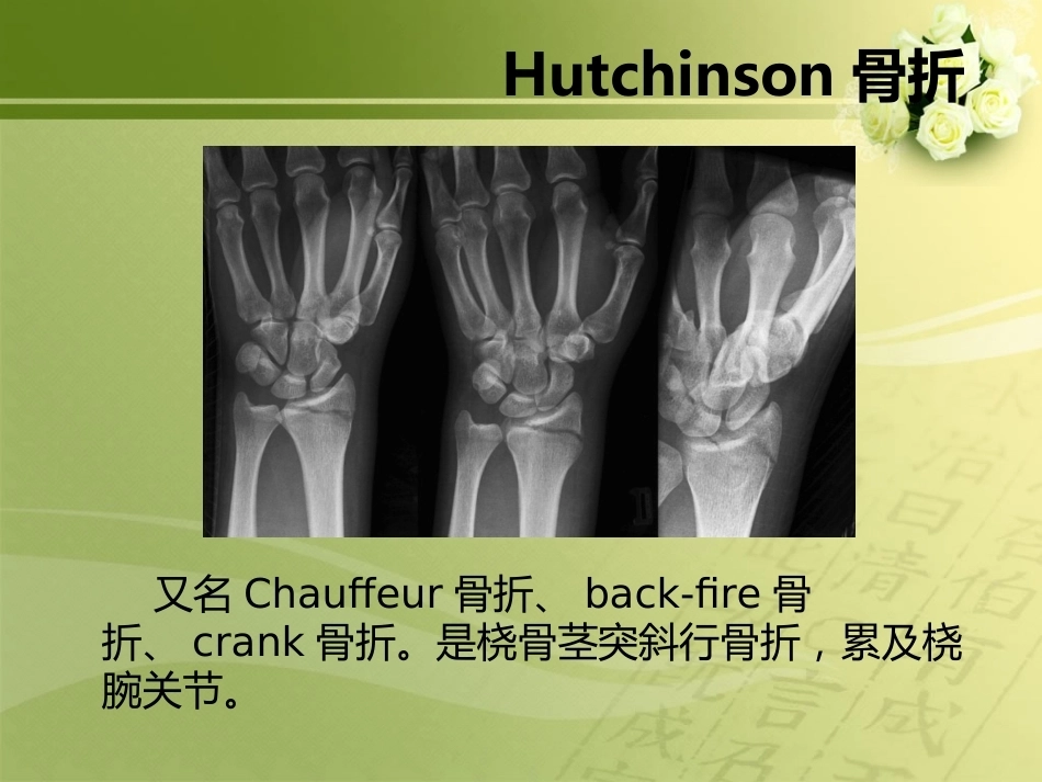 特殊类型骨折_第12页