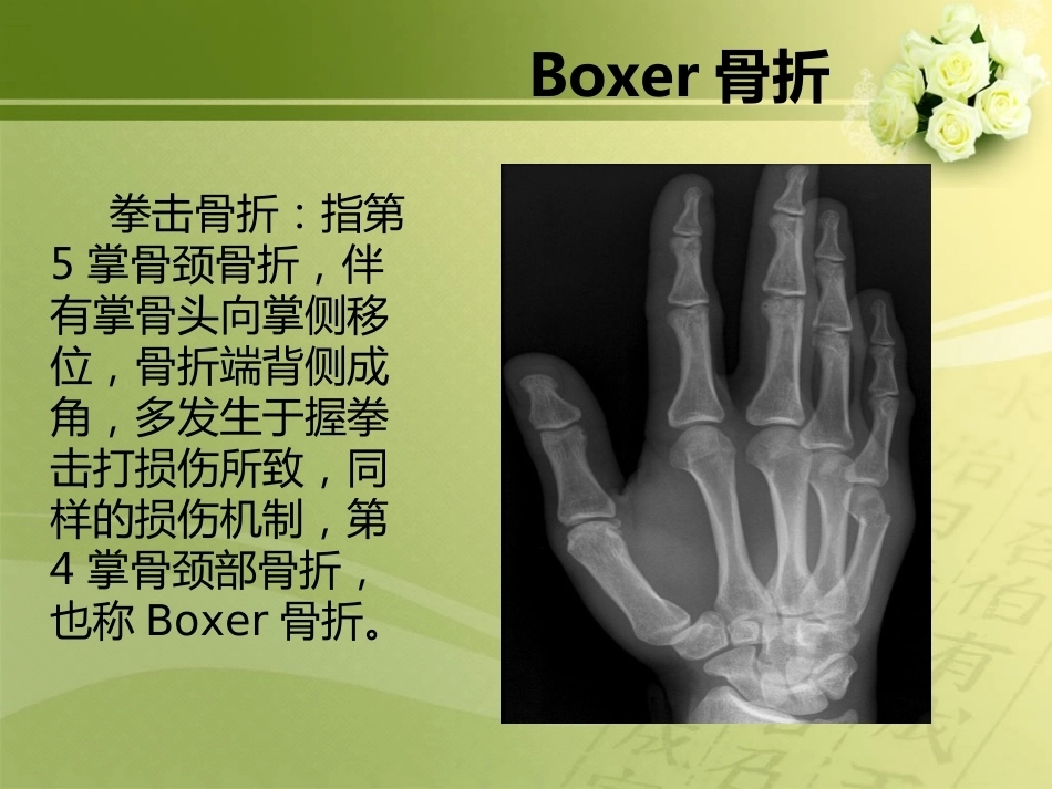 特殊类型骨折_第13页