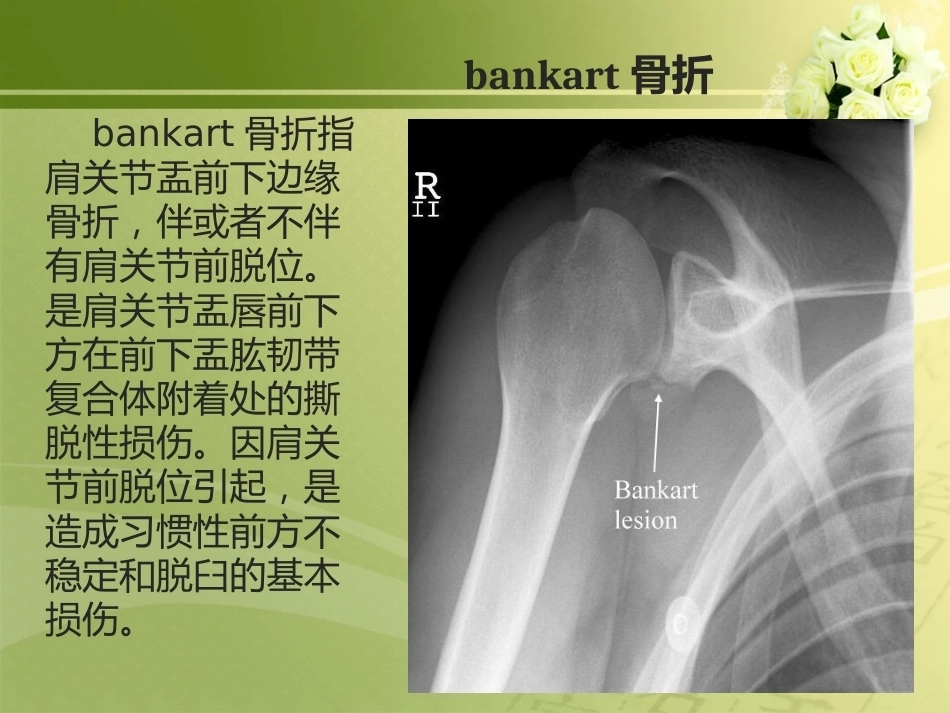 特殊类型骨折_第2页