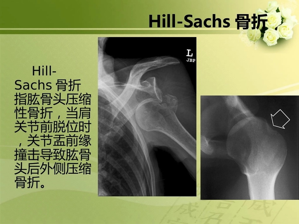 特殊类型骨折_第3页