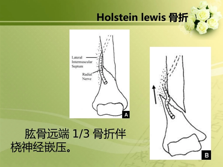 特殊类型骨折_第4页