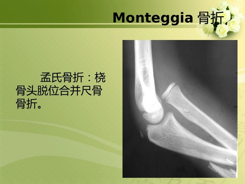 特殊类型骨折_第5页