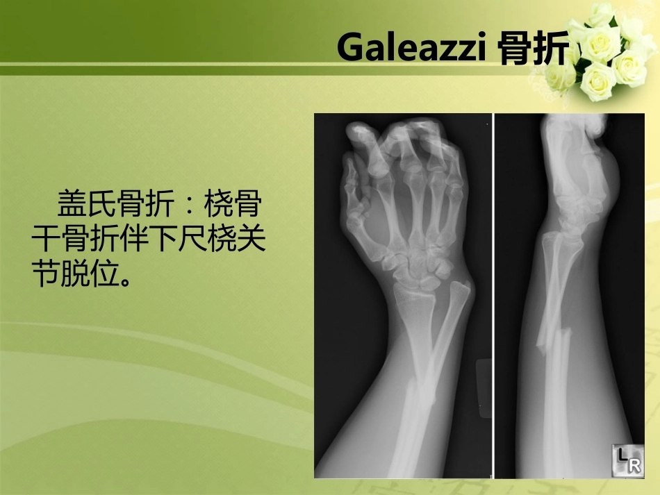 特殊类型骨折_第6页
