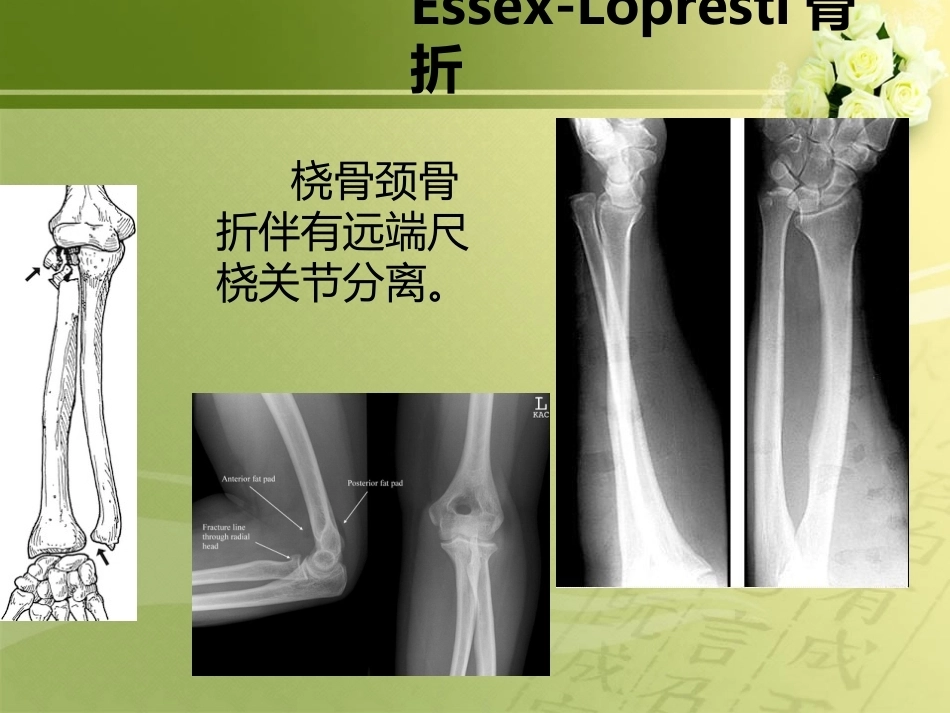 特殊类型骨折_第7页