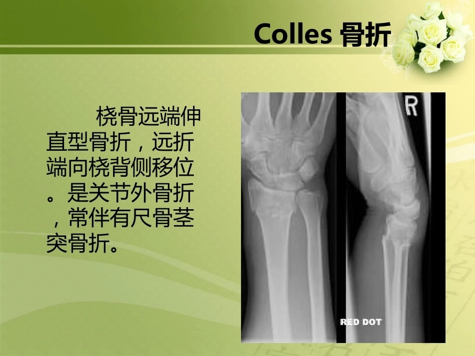 特殊类型骨折_第8页