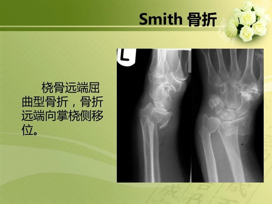 特殊类型骨折_第9页