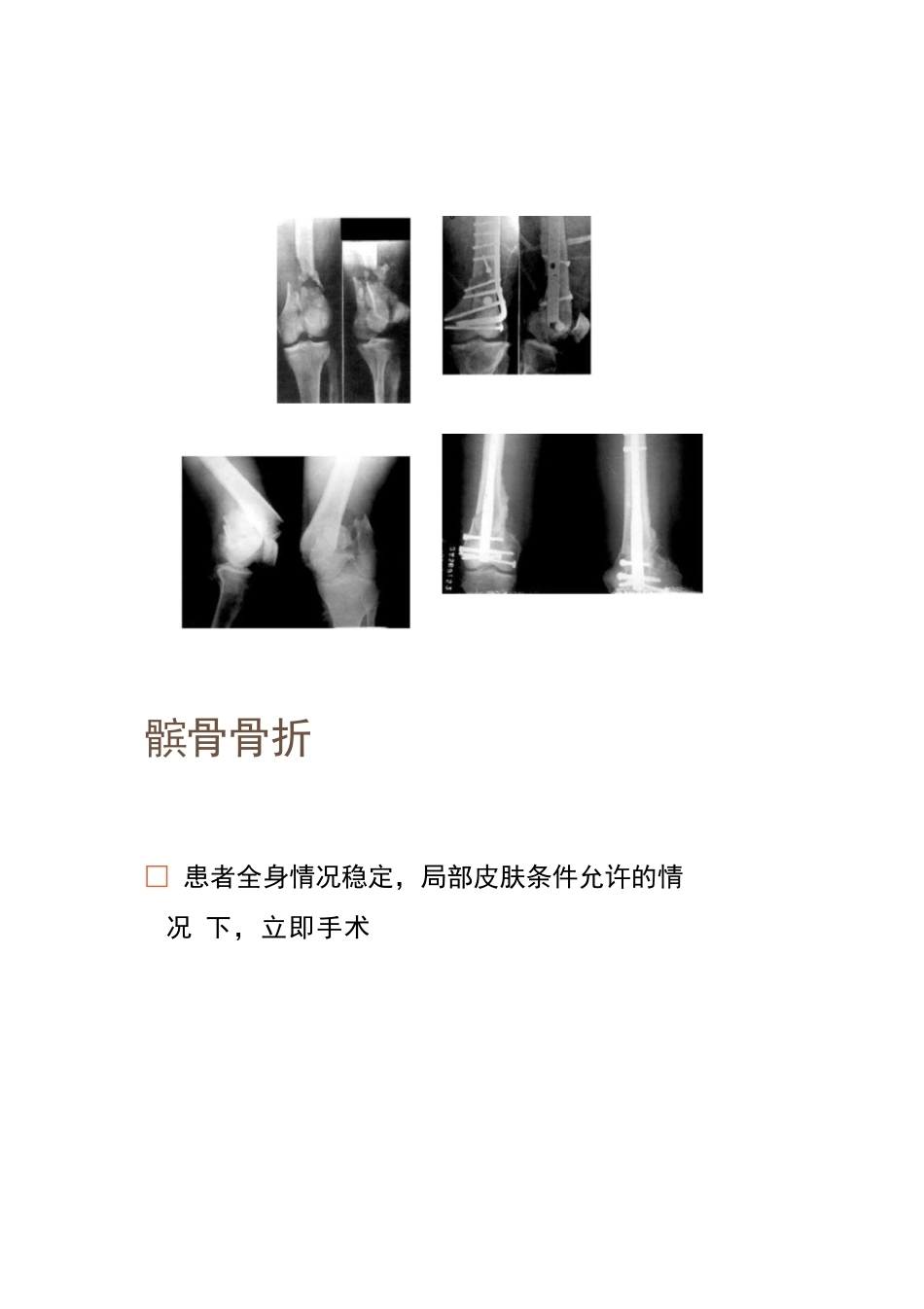 各部位骨折的手术 时机选择_第12页