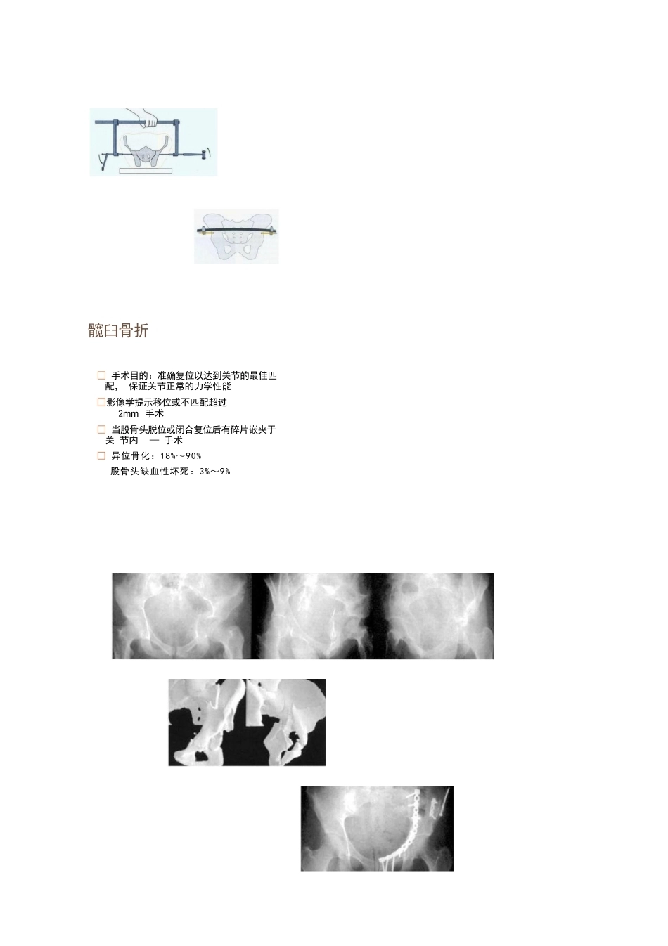各部位骨折的手术 时机选择_第8页