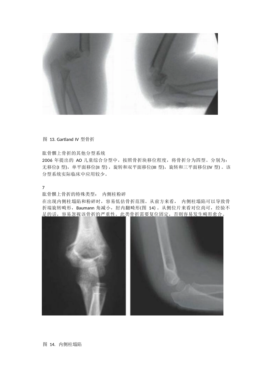 儿童肱骨髁上骨折的诊断 及治疗要点_第11页