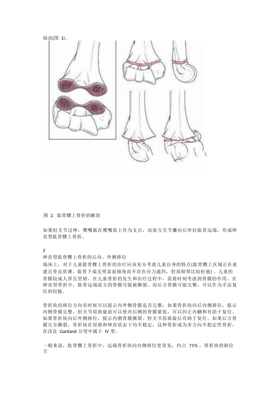 儿童肱骨髁上骨折的诊断 及治疗要点_第2页