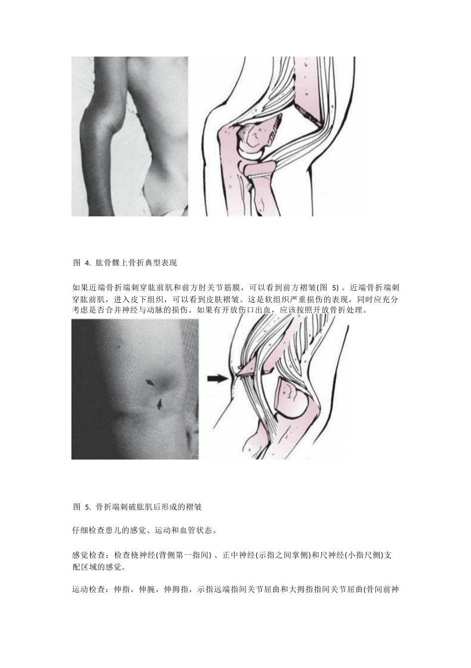 儿童肱骨髁上骨折的诊断 及治疗要点_第4页