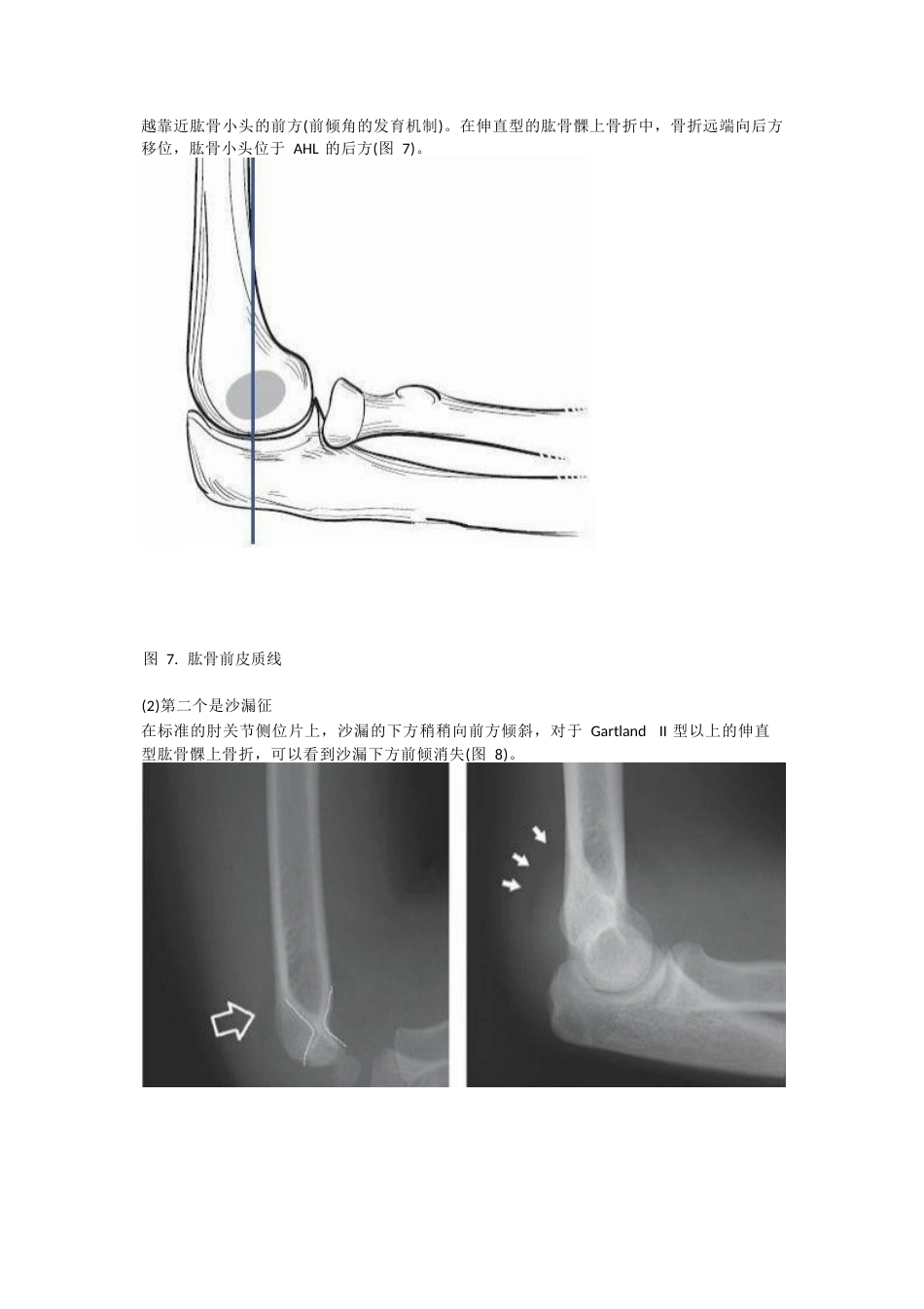 儿童肱骨髁上骨折的诊断 及治疗要点_第6页