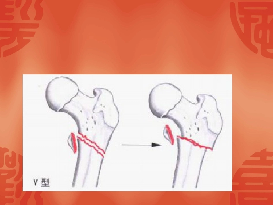 骨折常用分型_第11页