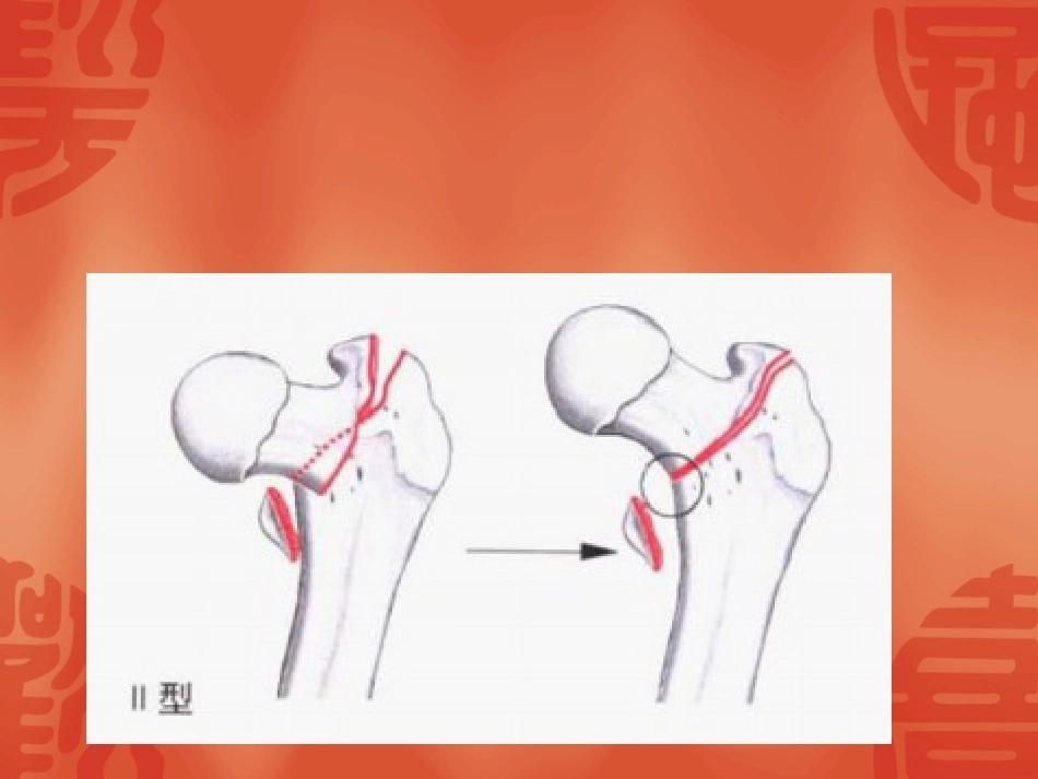 骨折常用分型_第8页