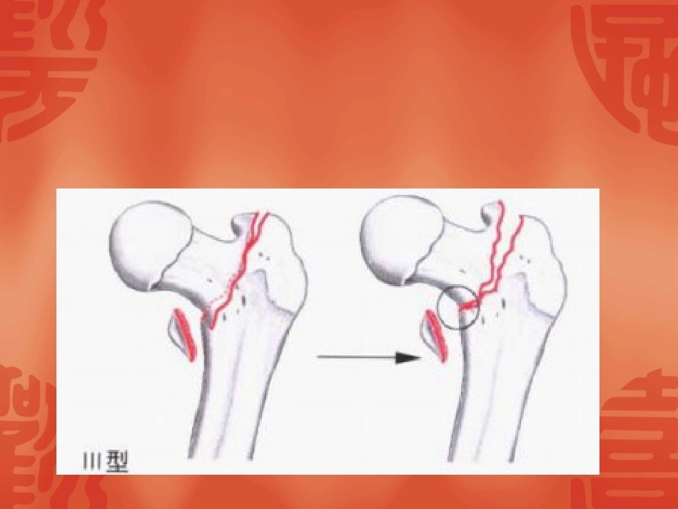 骨折常用分型_第9页