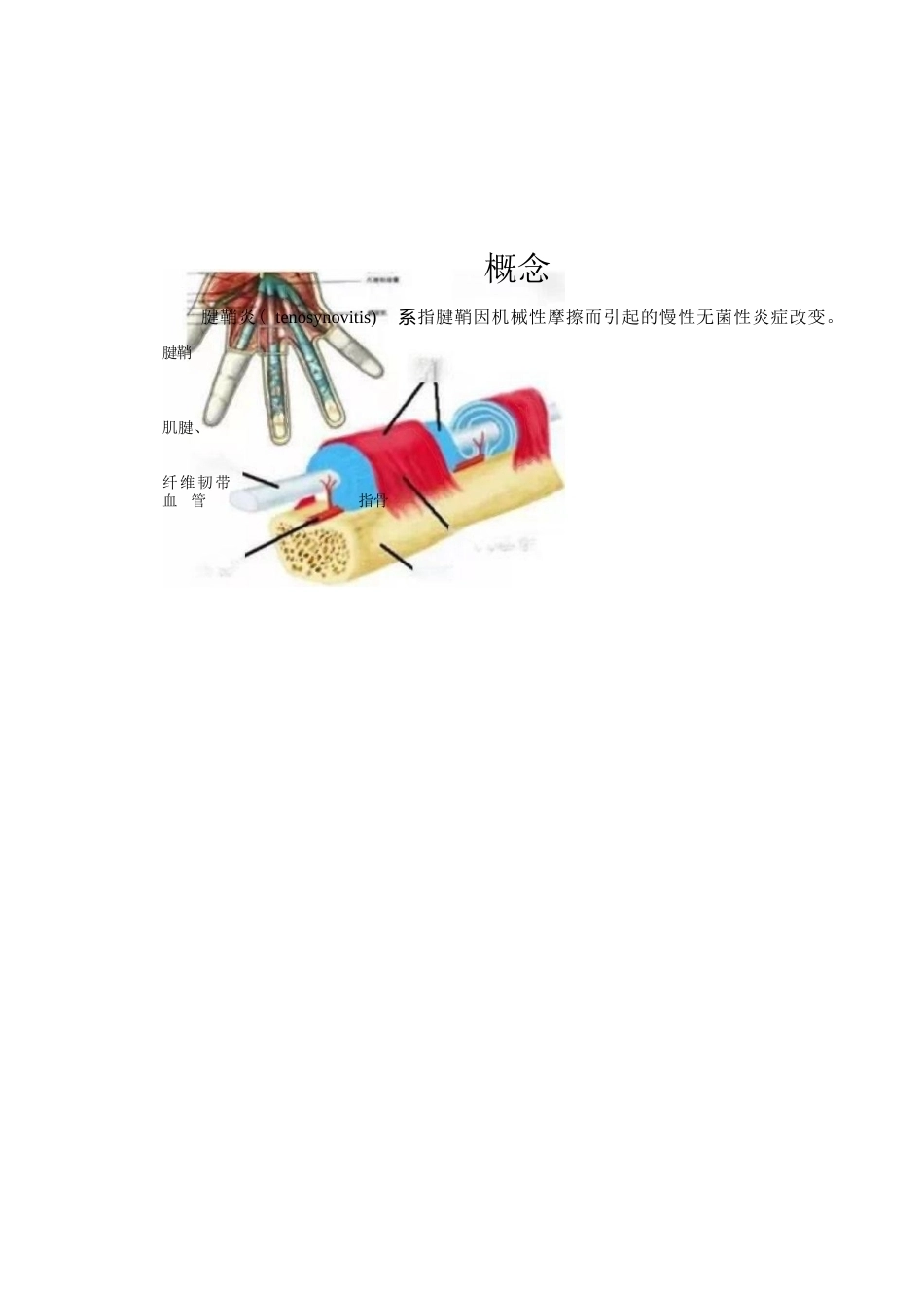 狭窄性 腱鞘炎的诊断及治疗_第1页