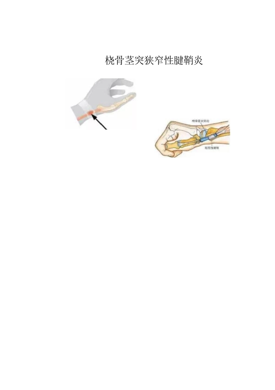 狭窄性 腱鞘炎的诊断及治疗_第10页