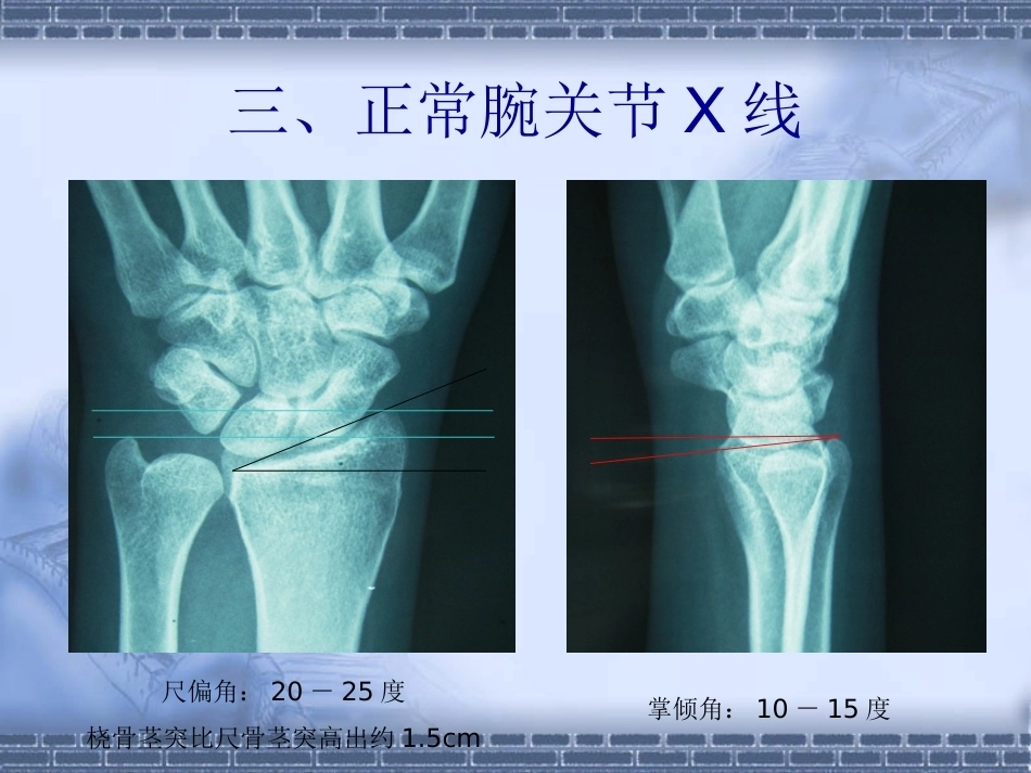 骨科colles-fracture_第14页