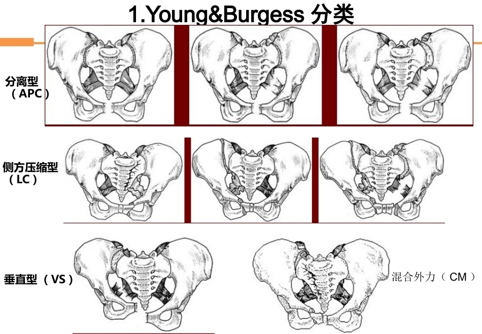 骨盆骨折-全_第10页