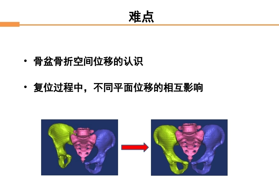 骨盆骨折-全_第13页