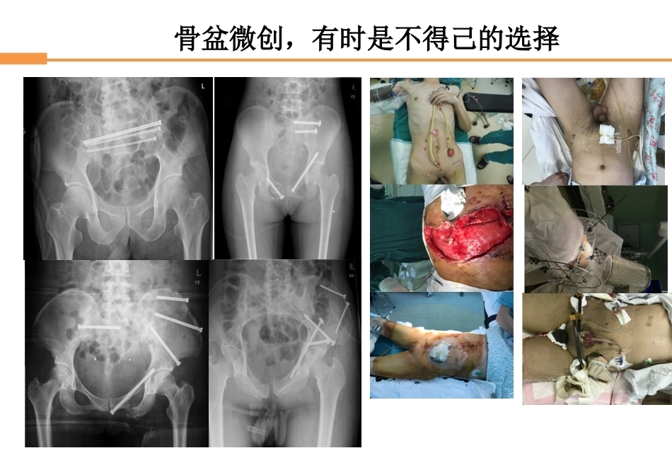 骨盆骨折-全_第8页