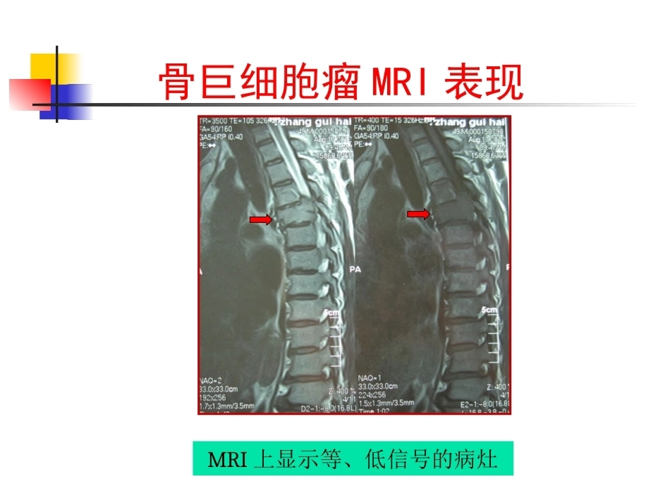 脊柱肿瘤诊断_第14页