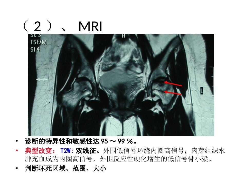 股骨头坏死的诊断及保 髋方法的选择_第13页
